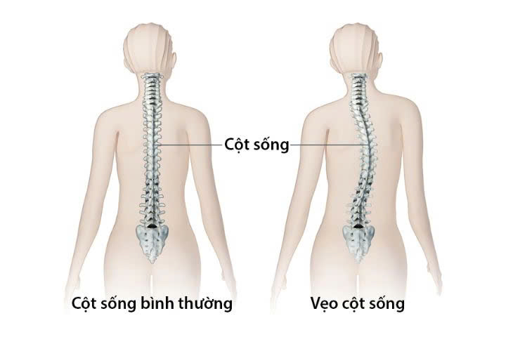 cong vẹo cột sống