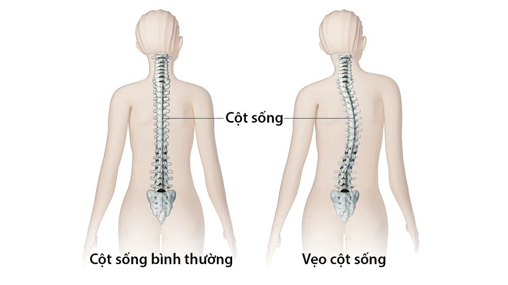 tác hại khi ngồi sai tư thế